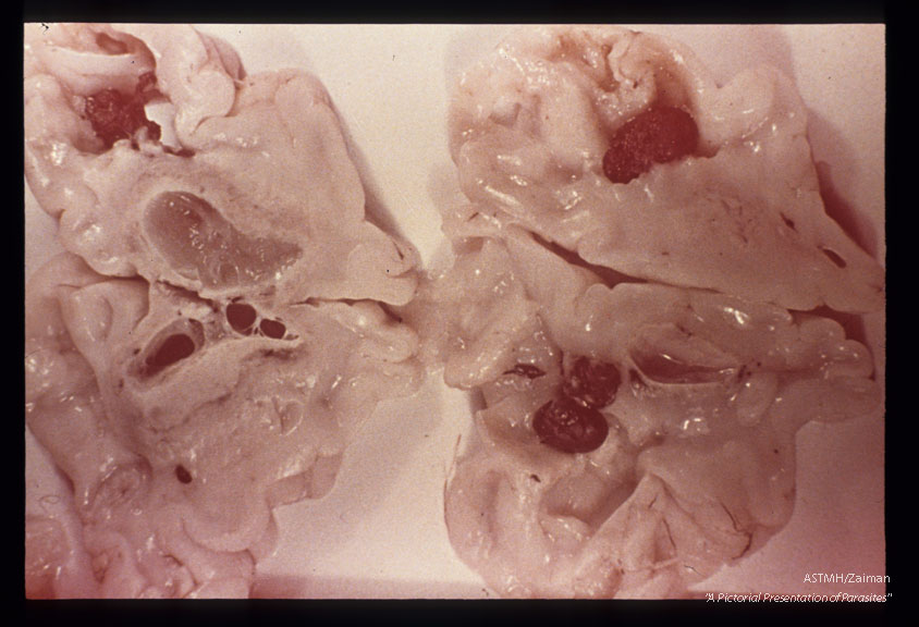 Toxoplasmic encephalitis, cross-section of brain showing periventricular necrosis and hemorrhage in the subependymal white matter, which is undergoing liquefaction.