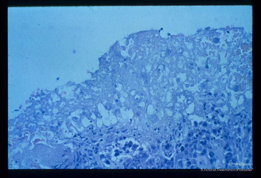 Two microscopic studies from the cervix of a lady suffering from squamous cell cancer of the uterine cervix with simultaneous amoebic cervicitis.