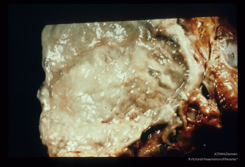 Opened liver abscess.