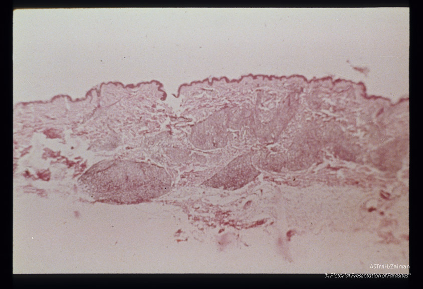 (South America). Hematoxylin-eosin stained section through a pseudo-lepromatous lesion.