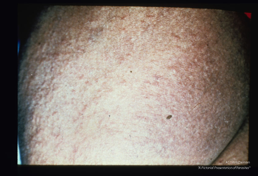 Mazzotti reaction in a Mexican child with facial edema and rash over deltoid region of the arm.