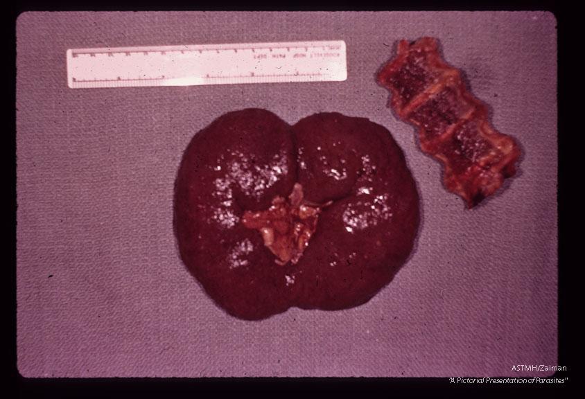 A 69 year old white male received 10 pints of blood shortly before,  during and after gastrectomy for a   benign gastric ulcer.    One of the donors,  a previously infected veteran of the Viet Nam war, registered at the blood bank under a false name and addrer Approximately four weeks after the surgery the patient developed a fatal case of falciparum malaria.  The deep brown color of kidney and bone marrow are indicative of pigment deposition.