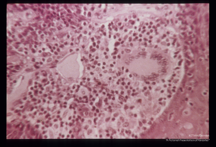(South America). Hematoxylin-eosin stained section showing tuberculoid reaction with Langhans type giant cells.