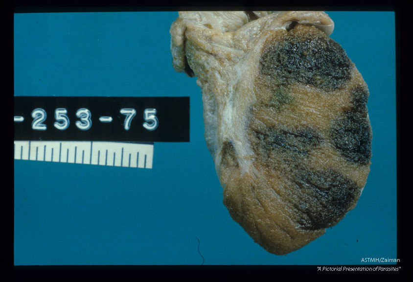 Section through the patient's testicle revealing hemorrhage caused by migrating mesocercaria.