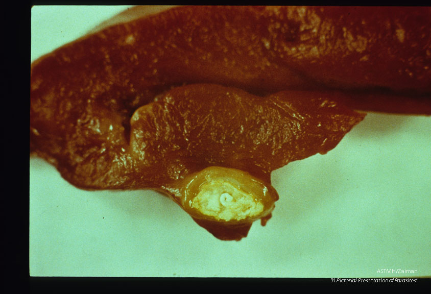 Cysticerci in beef heart.