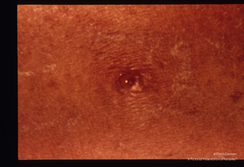 A W.V.U. medical student returning from a summer visit to Costa Rica had this skin lesion.