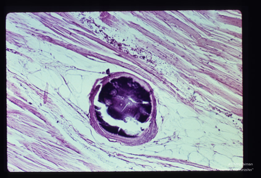 H and E. Old cyst undergoing calcification in muscle.