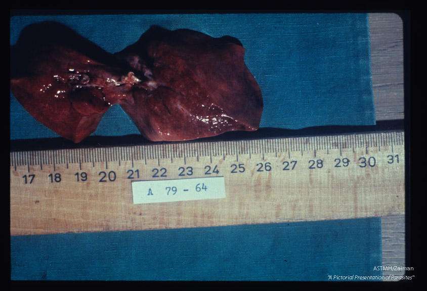 Lungs from infant dead from Pneumocystis pneumonia showing the characteristic brick red color and grooves due to rib pressure on expanded lungs. The parenchyme is dryer and paler than is usually true of bronchopneumonias.