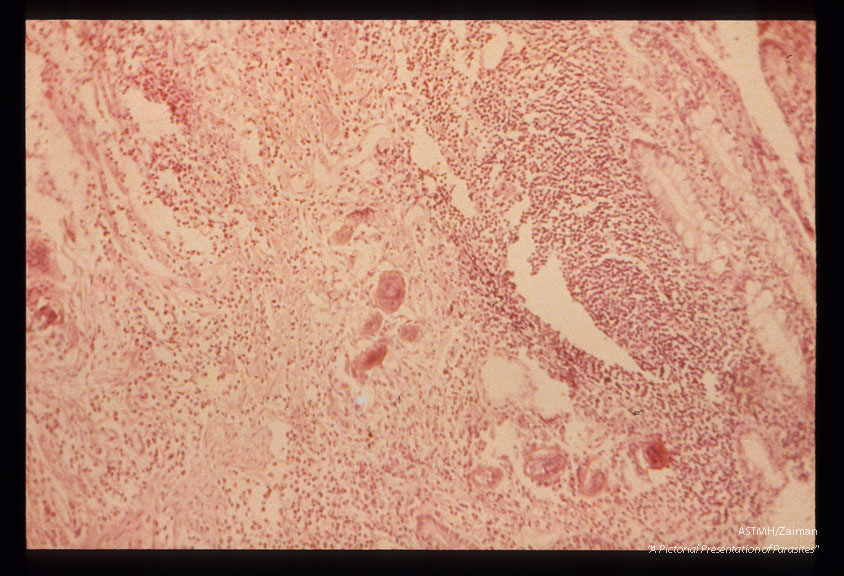 Section of rectum showing eggsand inflammatory infiltrate.