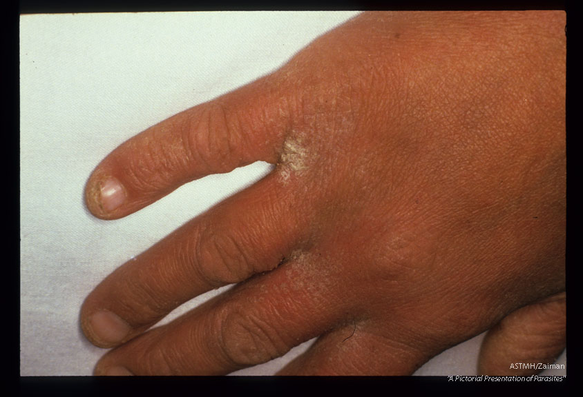 Severe skin lesions. "Norwegian scabies".