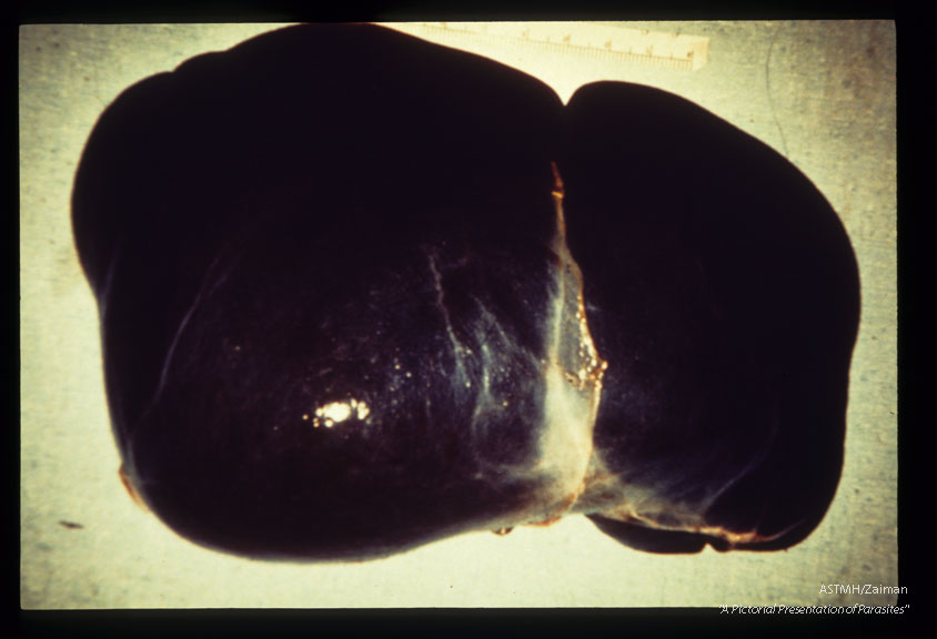 Enlarged, heavy pigmented liver.