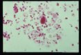 Microscopic views of amebae in brain lesions.