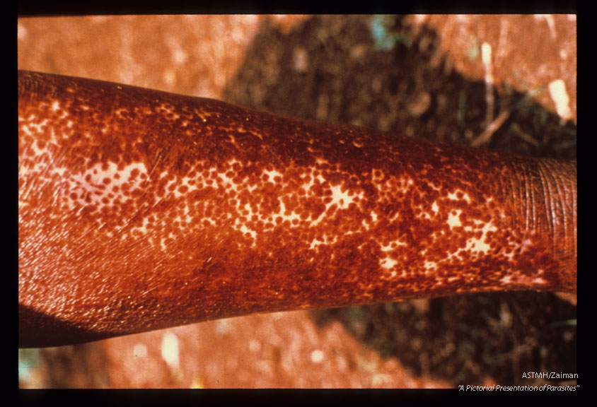 Characteristic leopard skin hyper-and hypopigmentation in the skin of a Liberian male.