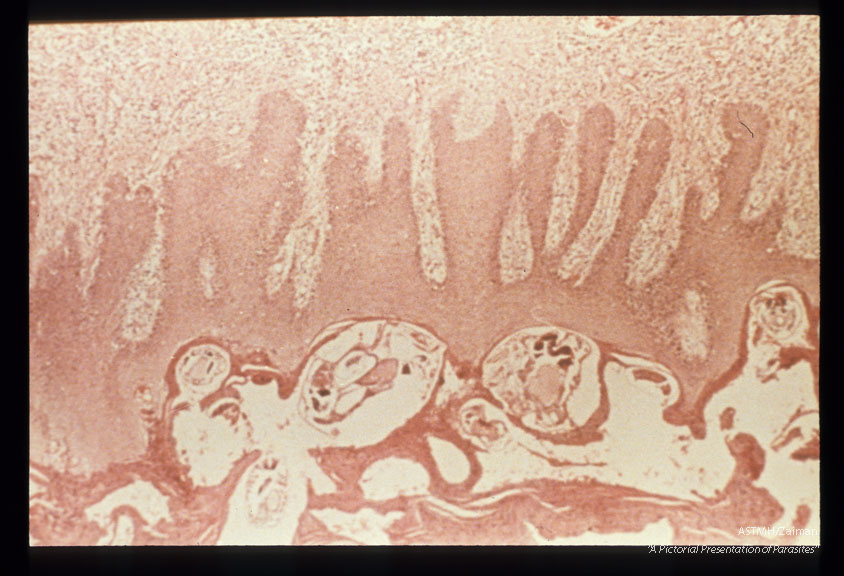 Microscopic section through skin showing mites in skin.