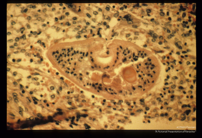 Mesocercaria in the patient's lymph node.