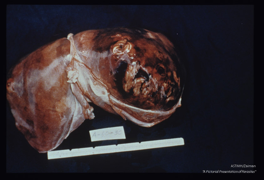 Gross pathology. Coiled nematode under liver capsule.