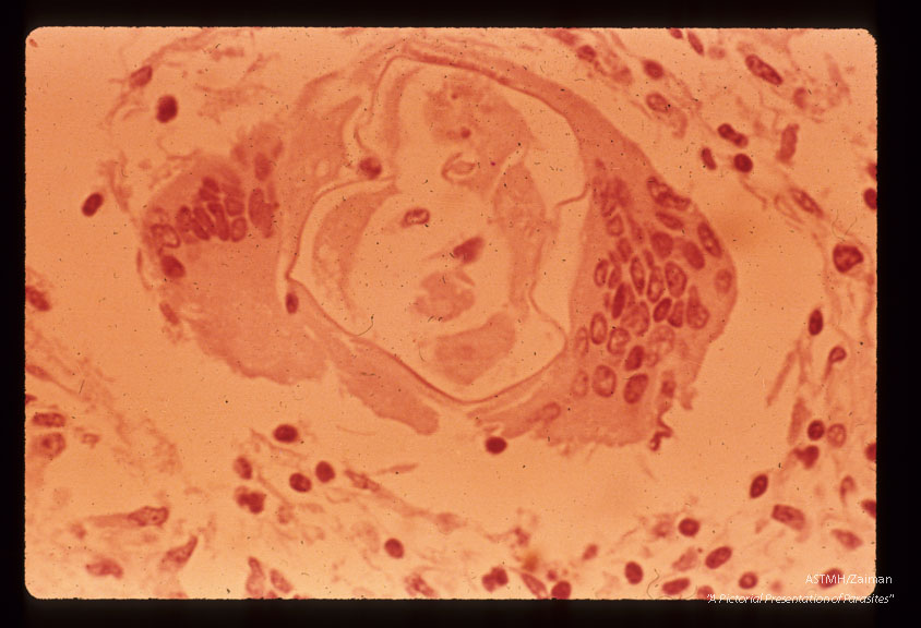 Cross section of nematode in monkey cord showing giant cell formation around worm.