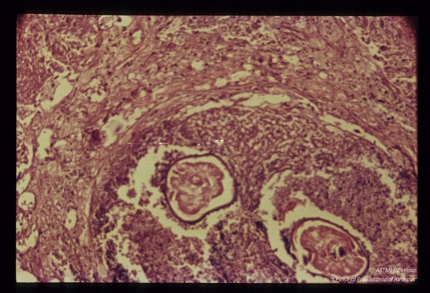 Lung nodule with cross section of filarial nematodes, probably adolescent Dirofilaria.