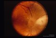 Juxtapapillary retinochoroiditis.