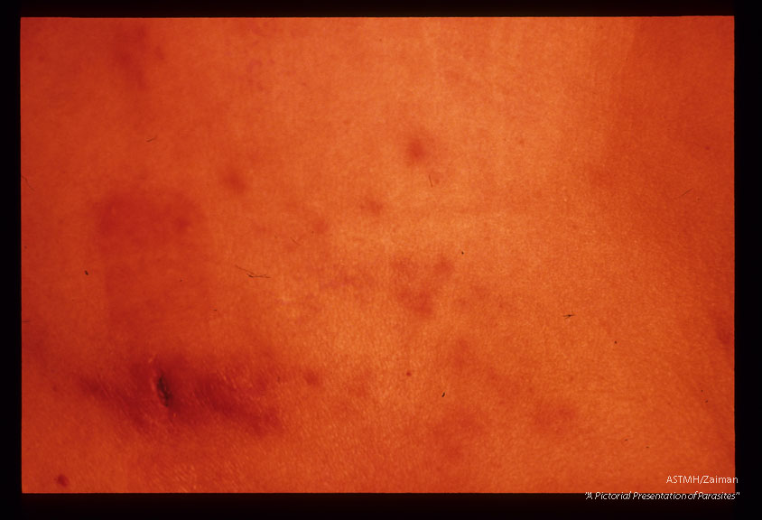 Skin lesions due to extra-genital schistosomiasis.
