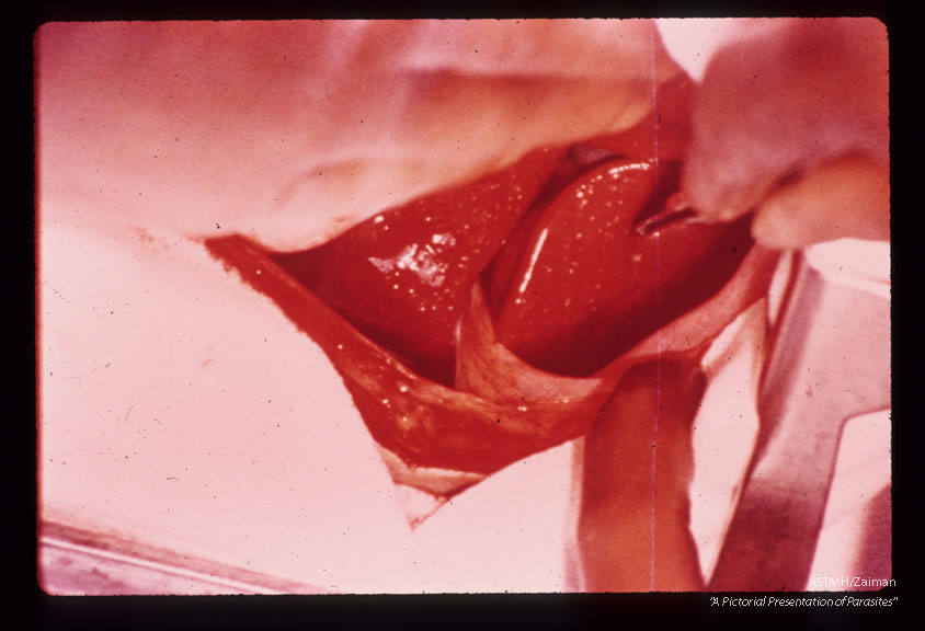 Liver at surgery showing numerous pseudotubercles.