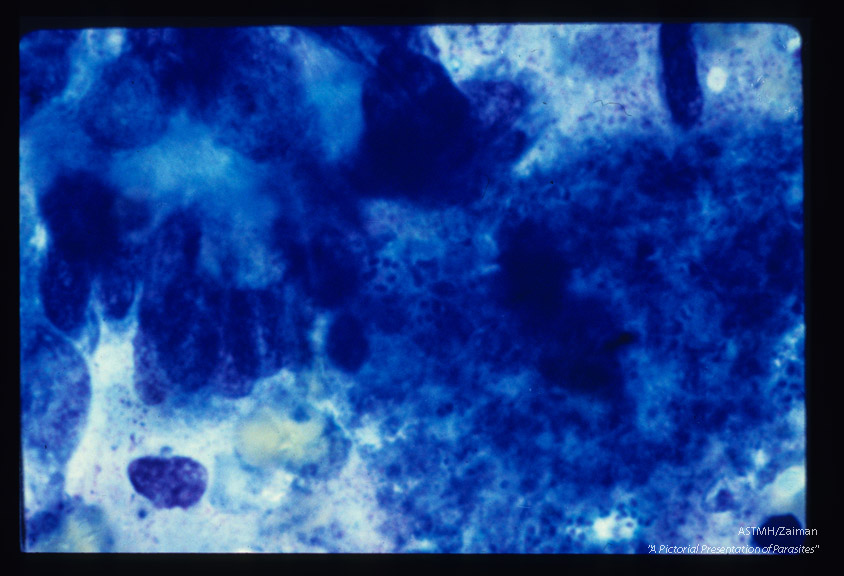 Pneumonia. Oil immersion view of alveolar material colored by Romanowsky type stain showing cyst like structures containing up to eight parasites.