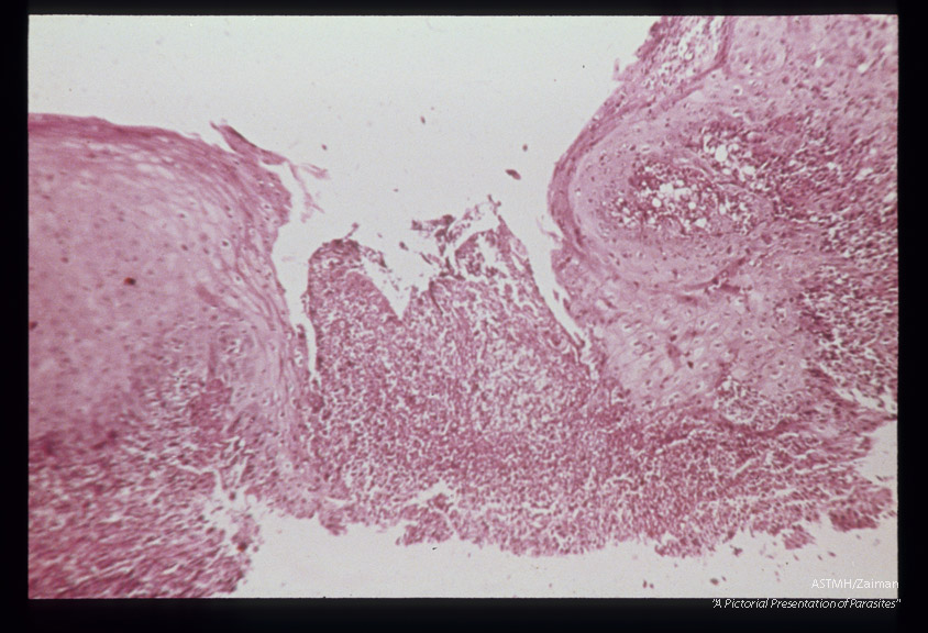 (South America). Hematoxylin-eosin stained section showing ulceration.