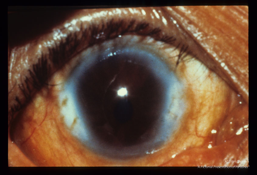 Early sclerosing keratitis with the characteristic pear shaped deformity, retropupillary fibrosis plus spontaneous subluxation of the cataractous lens. Forty-four year old Mexican male.