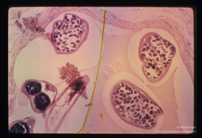 At higher power, the developing microfilariae and cuticle are seen.