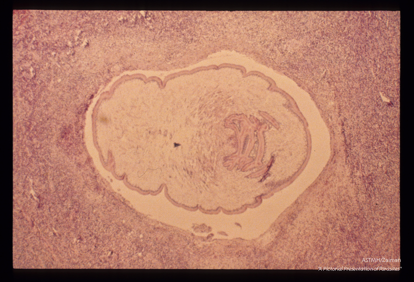 Human case. A cross section through the parasite shows typical tapeworm morphology. A dense neutrophilic infiltrate with many eosinophils is present in the adjacent muscle.