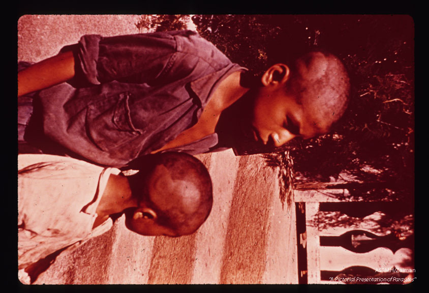 Nodule in scalp of two children.