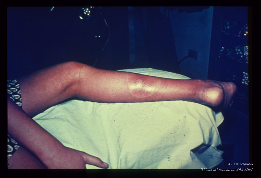 Inoculation site in a patient with acute Chagas' disease.
