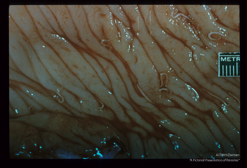 Adults woven into mucosa of 22 yr. old Chinese female. Ulcerating carcinoma seen in lower power photographs.