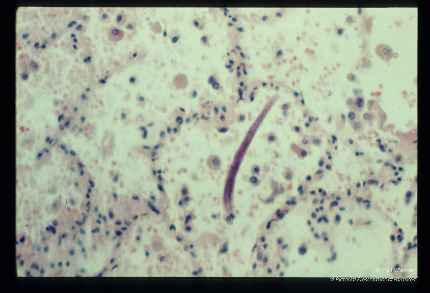 Larva in human alveolus. Pneumonic infiltrate present.
