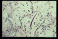 Larva in human alveolus. Pneumonic infiltrate present.