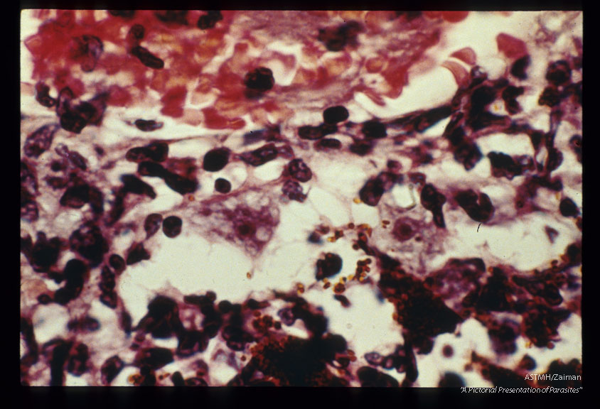 Fatal case with uveitis and meningoencephalitis. Trophozoite.