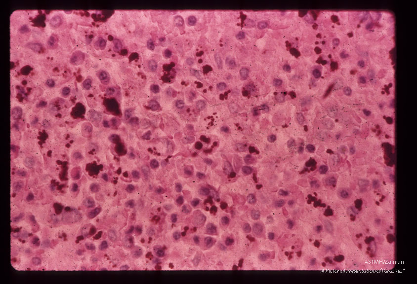 A 69 year old white male received 10 pints of blood shortly before,  during and after gastrectomy for a   benign gastric ulcer.    One of the donors,  a previously infected veteran of the Viet Nam war, registered at the blood bank under a false name and addrer Approximately four weeks after the surgery the patient developed a fatal case of falciparum malaria.  Demonstration of pigment in spleen of same patient at the microscopic level.