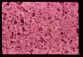 A 69 year old white male received 10 pints of blood shortly before,  during and after gastrectomy for a   benign gastric ulcer.    One of the donors,  a previously infected veteran of the Viet Nam war, registered at the blood bank under a false name and addrer Approximately four weeks after the surgery the patient developed a fatal case of falciparum malaria.  Demonstration of pigment in spleen of same patient at the microscopic level.