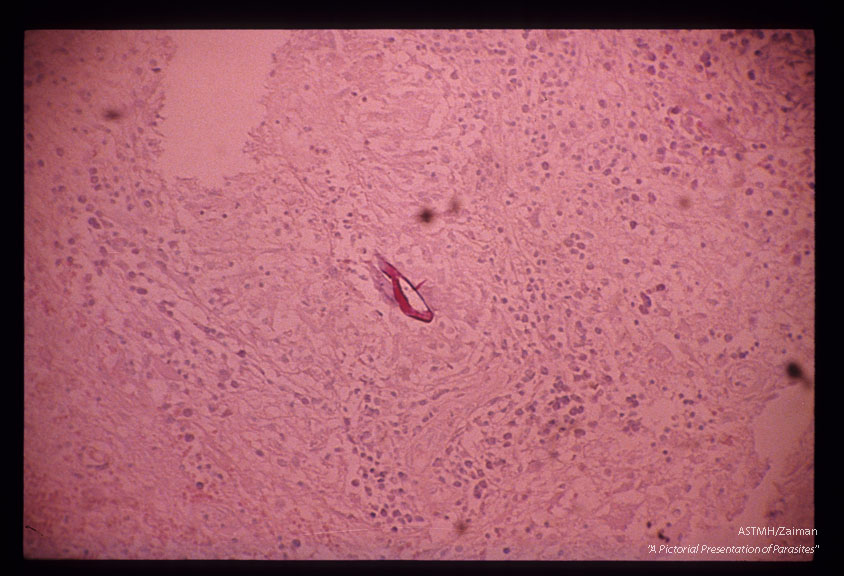 Acid-fast stain of egg in spinal cord.