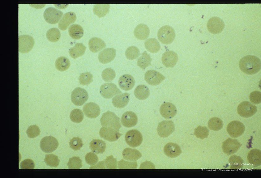 Giemsa stained slides from a fatal case on Fire Island, N. Y., (1982). The parasitemia is high for human babesiosis. Budding, multiply-infected erythrocytes, tetrad formation, band forms, reticulocytosis and clumping of extracellular parasites may be seen.