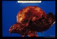 Gross and microscopic photos of human liver from Minnesota where about one half of the red foxes are infected.