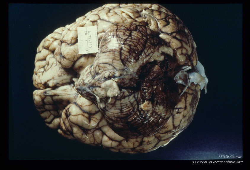 Fatal case with uveitis and meningoencephalitis. Gross pathology.