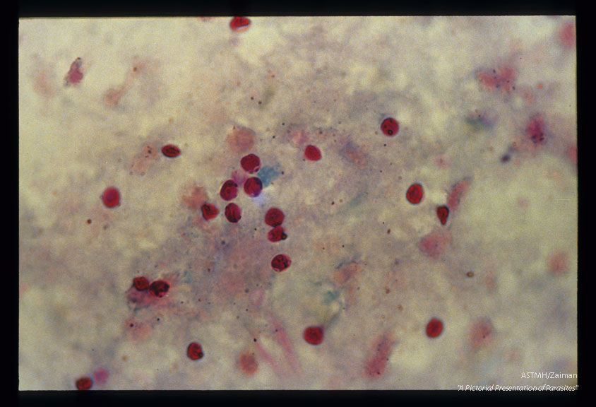 Stool specimens stained by hot acid fast technique.