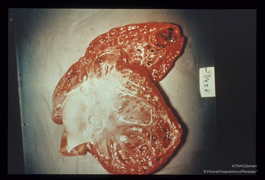 Gross pathology. Opened heart showing myocarditis in Chagas' disease.