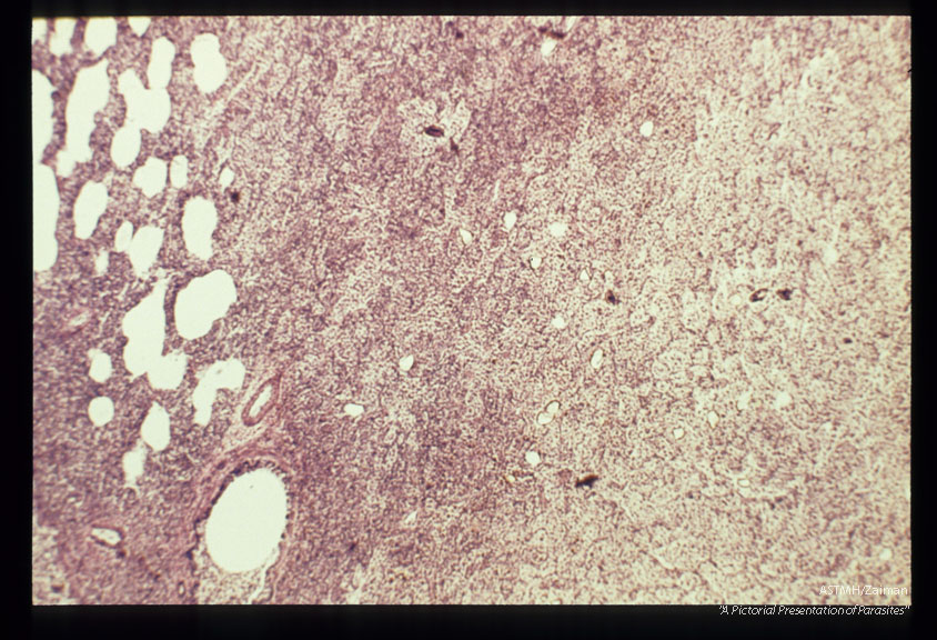 Granulomatous reaction around eggs in lung.