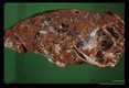 Infected bovine liver.