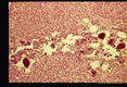 Eggs in armadillo (Dasypus novemcinctus) liver.