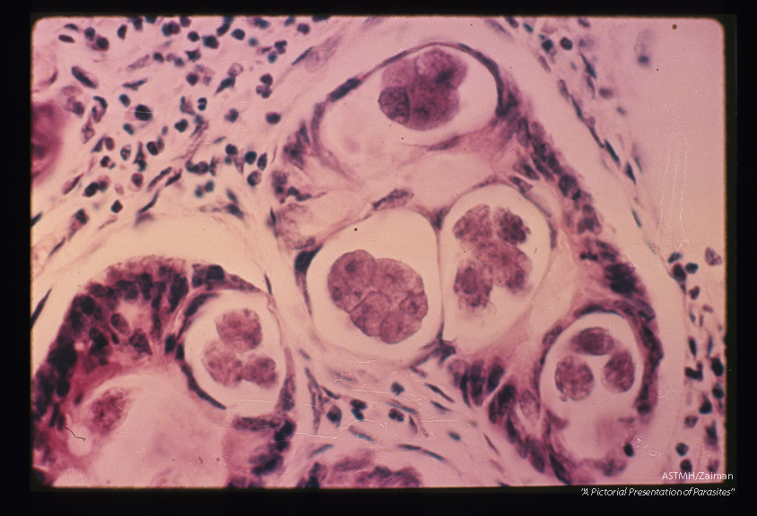 Human bowel. Five eggs in various stages of development are seen in the crypts of the bowel.