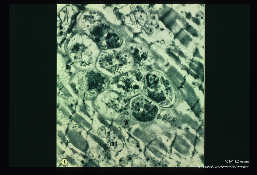 Ultrastructure of parasite in human heart muscle. Several organisms are seen in this photograph; of these, one shows a double conoid suggesting that it is dividing. do-mitochondrion of parasite, mt-mitochondria of heart muscle cell, w- cyst wall, z-z-membrane of myofibre