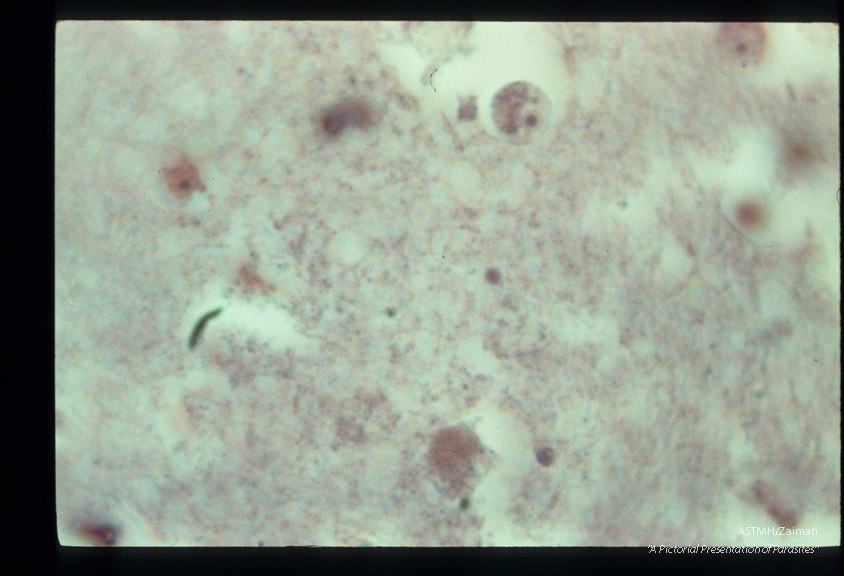 Brain with trophozoites, H & E.